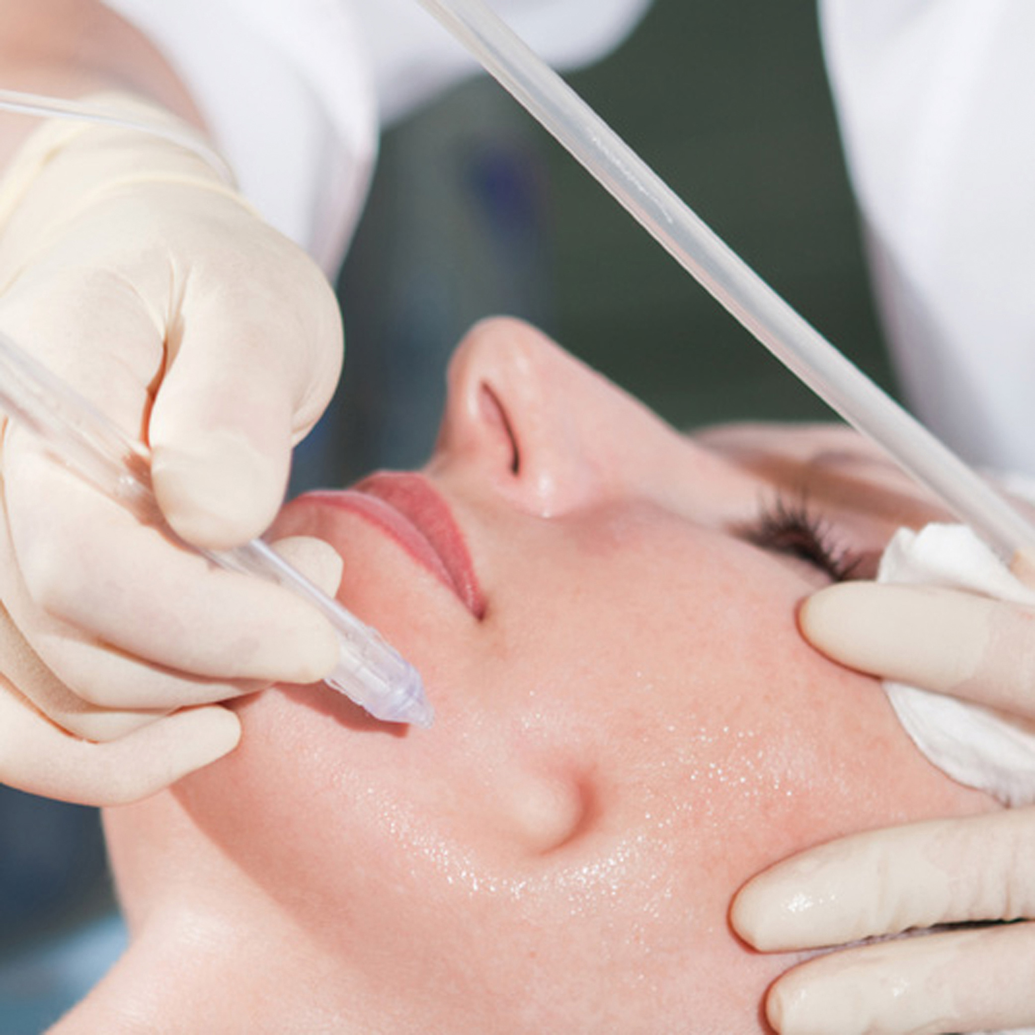 JetPeel-Behandlung-01 DIE ANTI-AGING WELTNEUHEIT: JETPEEL jetzt in Lübeck!