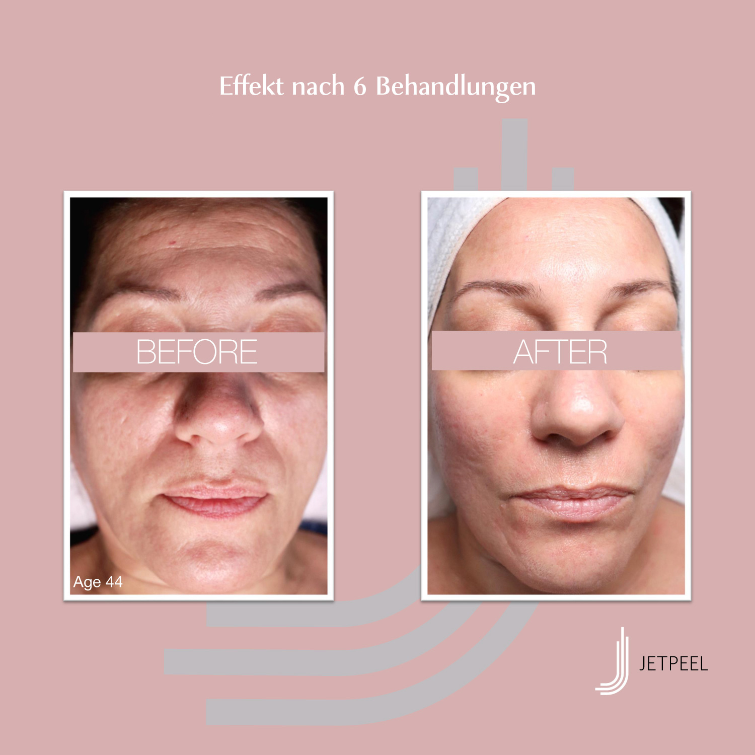 Landsberg-JetPeel-Before-After-Image-Anti-Aging-01 DIE ANTI-AGING WELTNEUHEIT: JETPEEL jetzt in Lübeck!