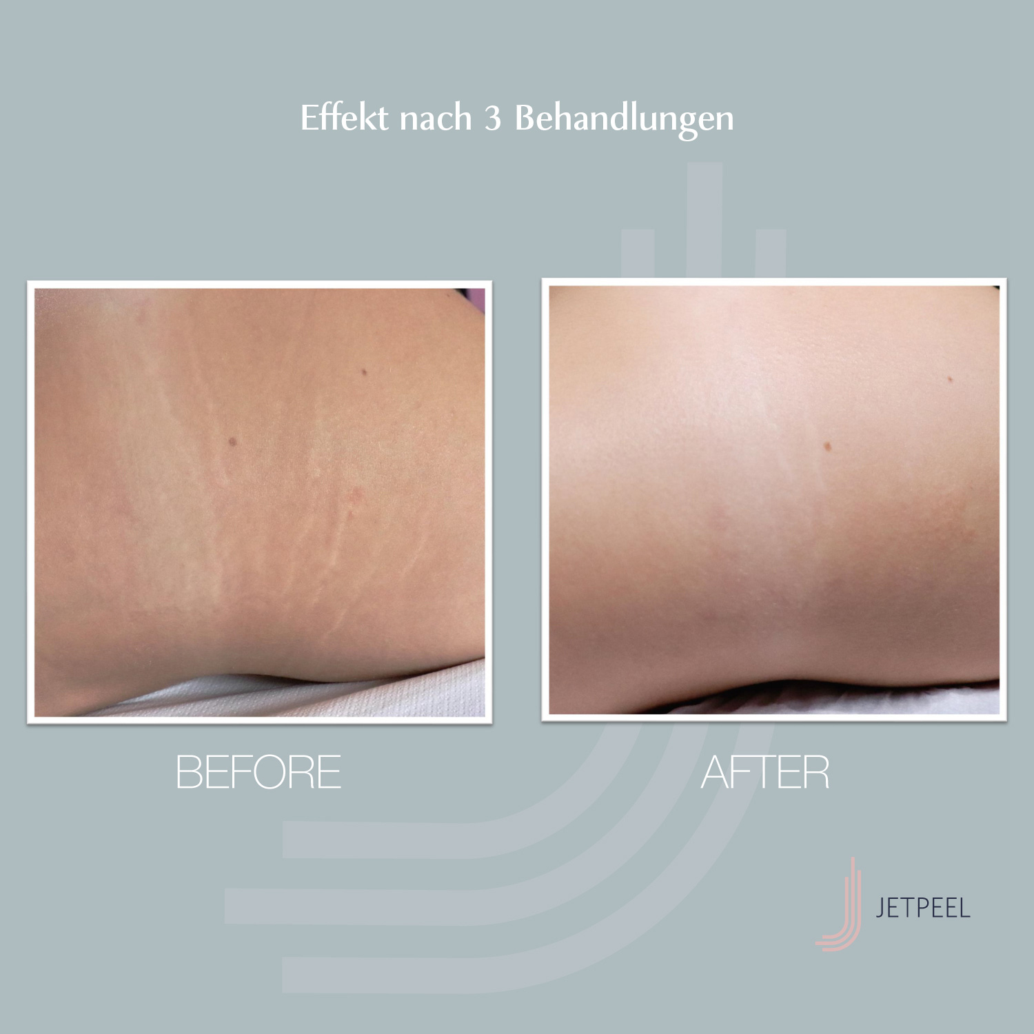 Landsberg-JetPeel-Before-After-Image-Strech-Marks DIE ANTI-AGING WELTNEUHEIT: JETPEEL jetzt in Lübeck!